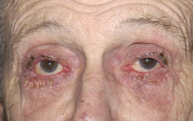 Bệnh Glaucoma ở người già